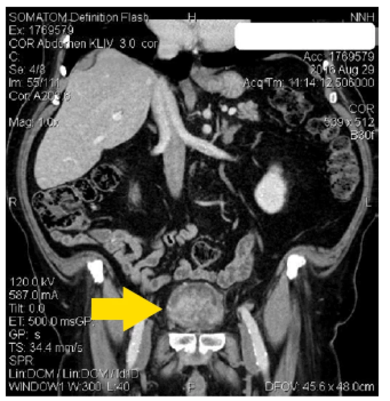 CT břicha s objemným tumorem močového měchýře
Fig. 1. CT scan of abdomen with large tumor of urinary bladder