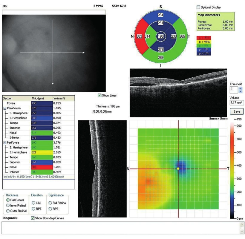 OCT snímok (mapa) ľavého oka. Výrazné defekty, atrofické zmeny RPE prevažne subfoveolárne, s edémom aj seróznou abláciou neuroretiny prevažne v nazálnych sektoroch. Nález po 10 intravitreálnych aplikáciách pagaptanibu