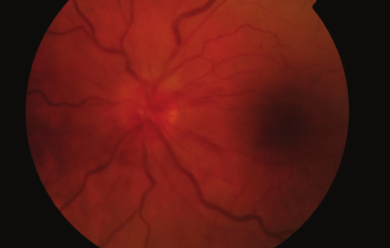 Fundus levého oka při zahájení léčby