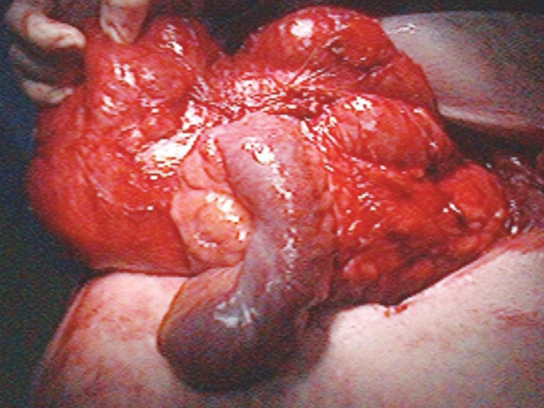 Obsah kýlního vaku
Fig. 7. Content of the hernial bag