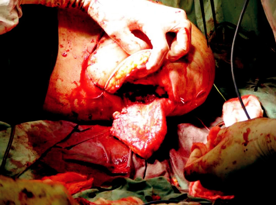 Exarticulation of the left upper extremity in shoulder