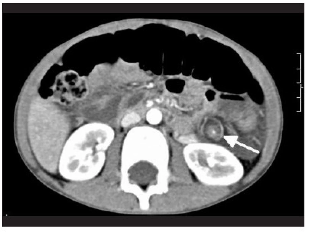 CT angiografia torzie lienálnej artérie s redukciou krvného prietoku
Fig. 5. CT angiography of splenic artery torsion with reducing blood flow