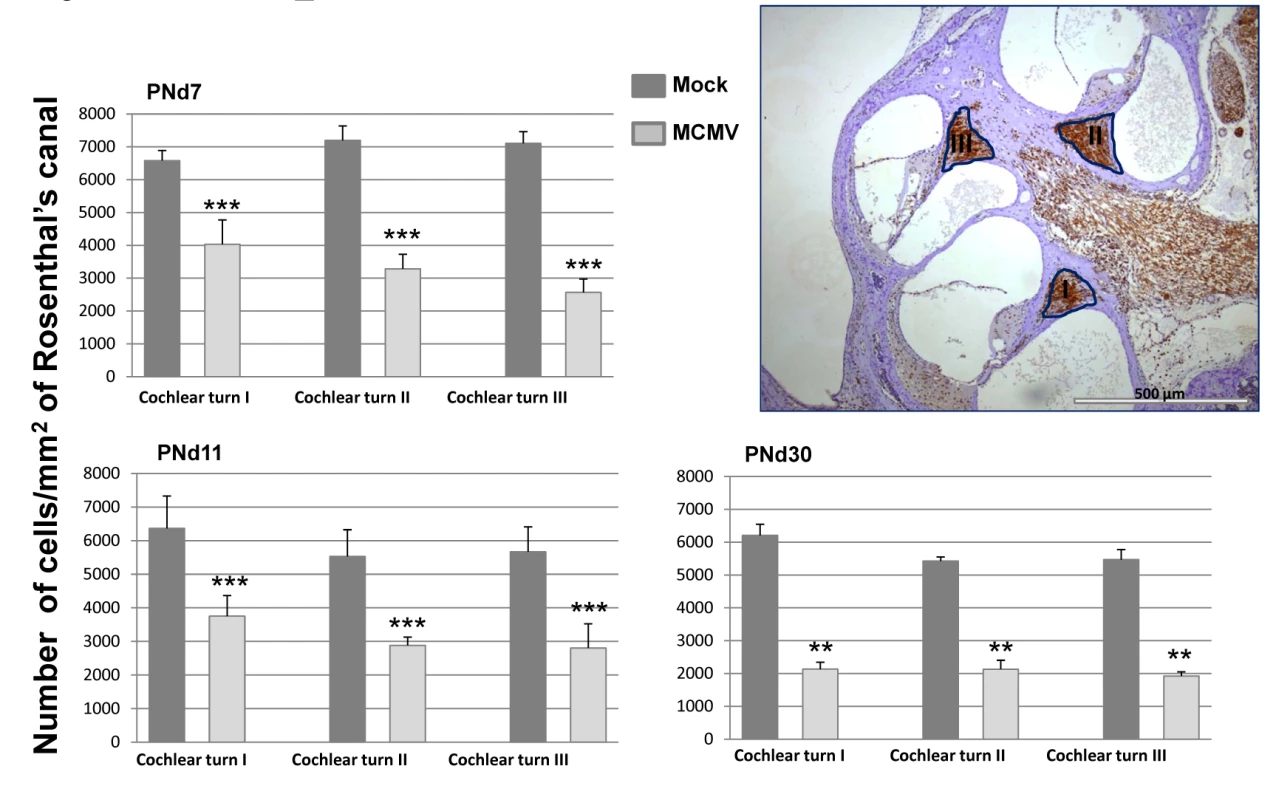 Loss of spiral ganglion neurons in mice infected in newborn period with MCMV.