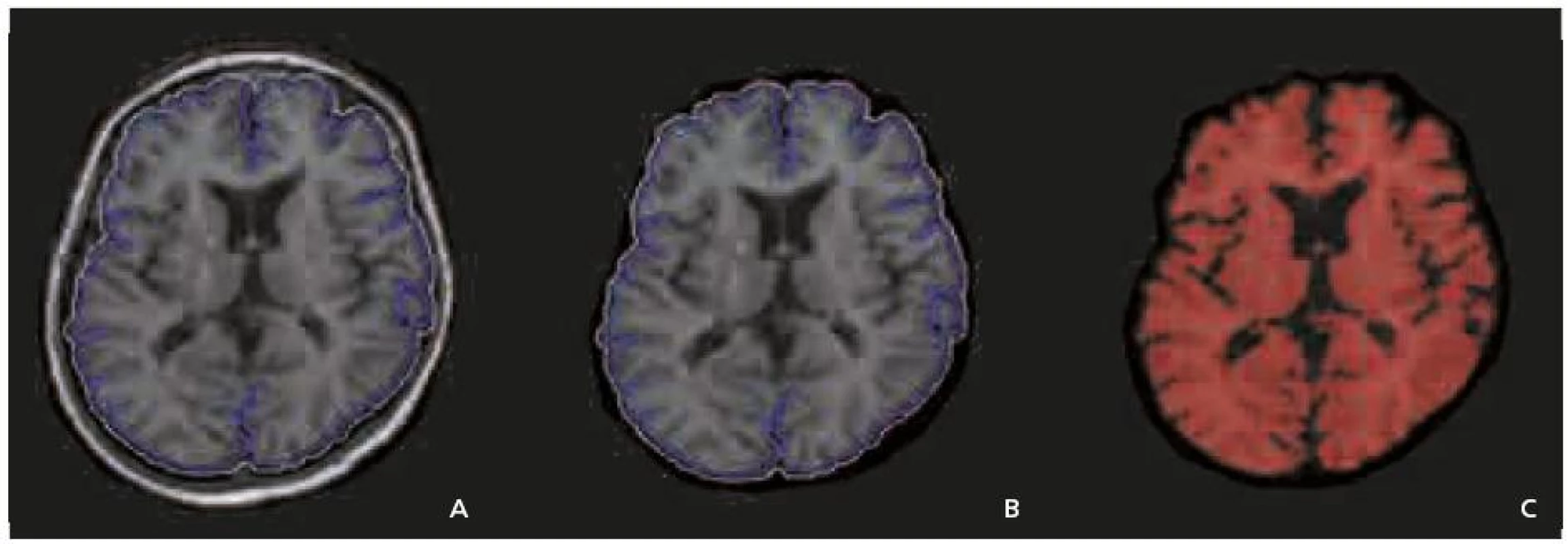 a–c. Metodika měření atrofie, určována jako brain parenchymal fraction (BPF) – poměr mozkové tkáně k objemu
mozku a likvorových prostor.
Zpracování obrazu je obdobné jako při měření objemu ložisek. Poté je provedeno automatické odstranění skalpu. Použití morfologických a filtračních operací má za úkol zvýraznit mozkový parenchym, který pak je definován jako oblasti o signálové intenzitě 3 500 nebo vyšší.