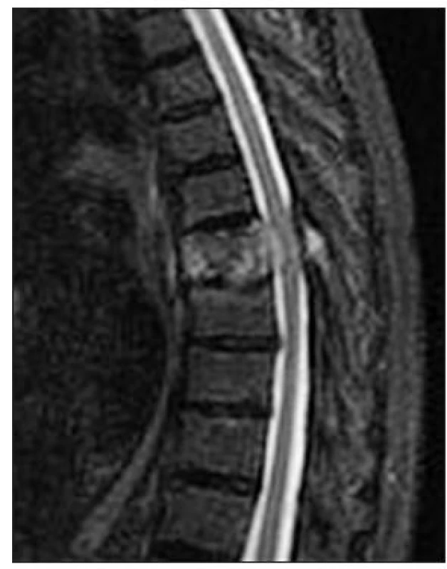 MRI (T2-vážené) hrudní páteře v sagitální rovině. Průkaz hemangiomu obratle Th7 s propagací do kanálu páteřního s kompresí míchy a myelopatií
Fig. 1. Sagittal MRI (T2-weighted) of thoracic spine. Detection of hemangioma of TH7, protruding into the spinal canal, spinal cord compression and myelopathy
