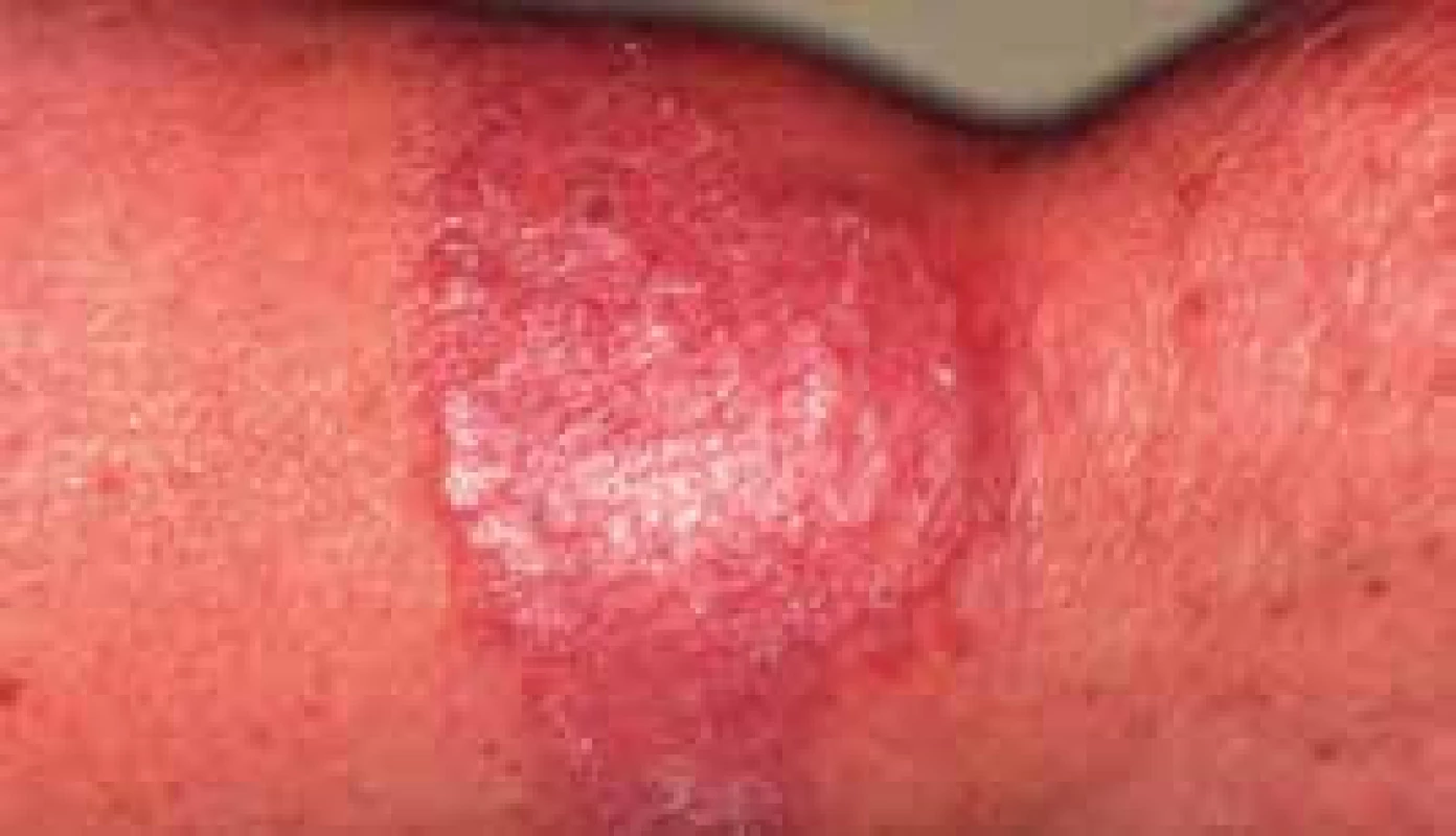 Hlboká, raritná mykóza (phaeohyphomycosis) u pacientky od detstva liečenej na DM, vyvolaná Phaesclera dematoides a Alternaria alternata