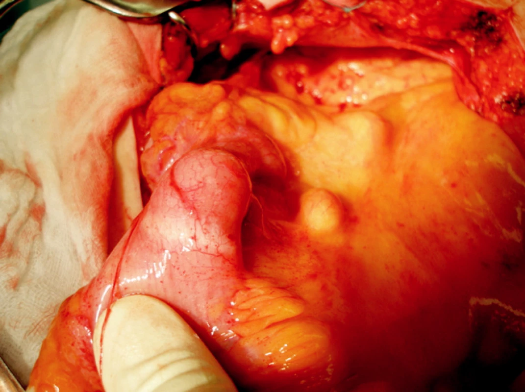 Resekáty rekta a pravé poloviny tračníku: patrny
objemné lymfomy, mezokolon vzestupného tračníku
masivní infiltrace uzlin
Fig. 4. Specimens with rectal and caecal lymphoma;
massive mesenteric lymh node infiltration is remarkable