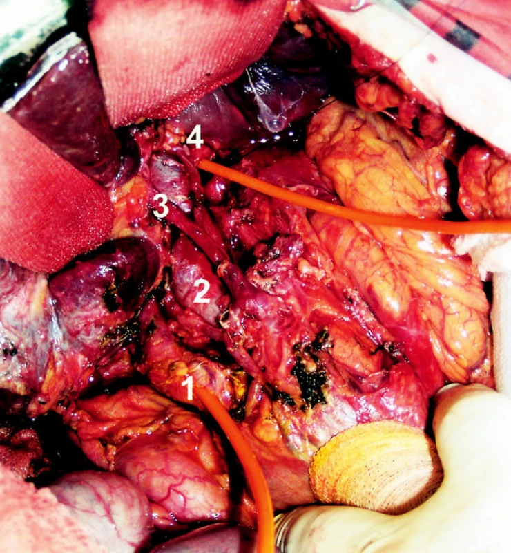 Peroperační foto
Fig. 2. A peroperative view
1 – ductus hepatocholedochus s choledochotomií a vstupující cévkou, 2 – véna portae, 3 – ramus dexter arteriae hepaticae propriae, 4 – ductus hepaticus sinister s hepatikotomií a vystupující cévkou.
1 – ductus hepatocholedochus with choledochotomy and an entering drain, 2 – v. portae, 3 – r. dexter arteriae hepaticae propriae, 4 – ductus hepaticus sinister with hepaticotomy and an entering drain.