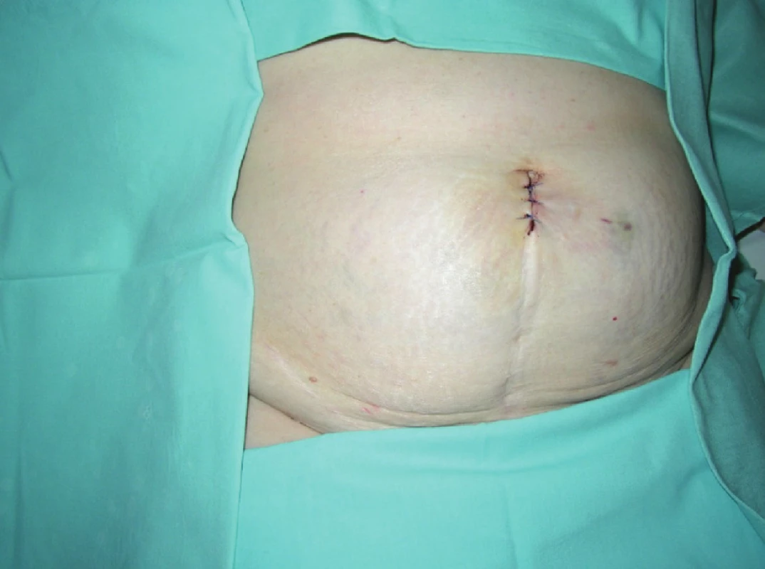 Operačná rana po SILS porte v jazve po dolnej laparotómii
Fig. 4. SILS port wound in low middle laparotomy scar