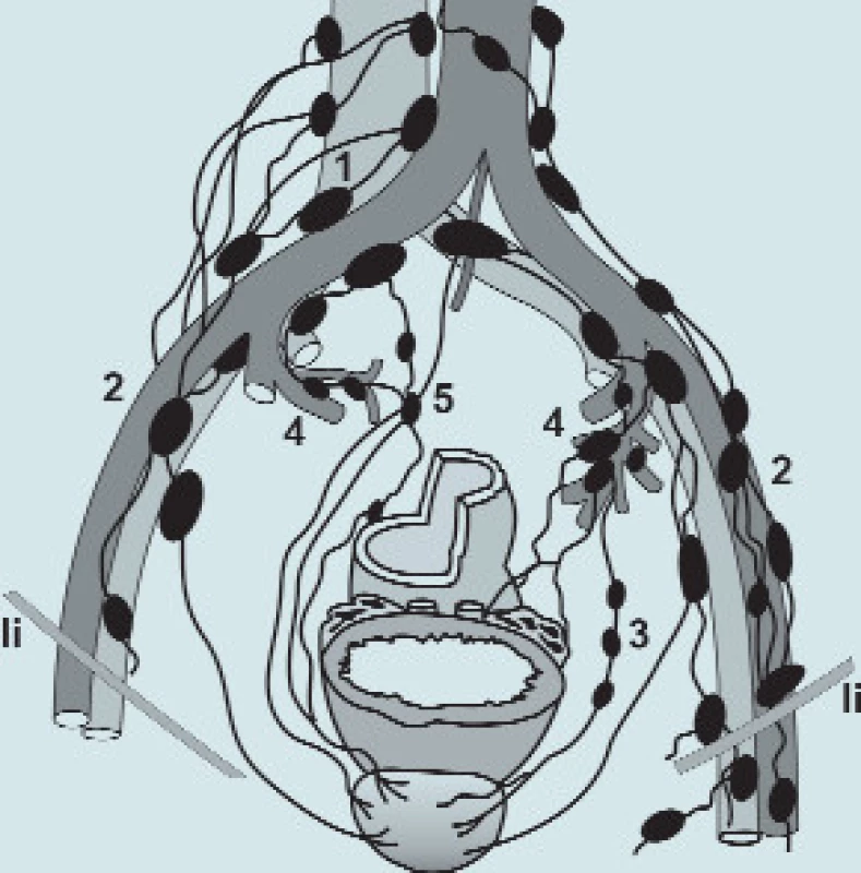Mízní uzliny pánve:
1 - nodi lymphatici iliaci communes
2 - nodi lymphatici iliaci externi
3 - nodi lymphatici obturatorii
4 - nodi lymphatici iliaci interni
5 - nodi lymphatici sacrales
li -ligamentum inguinale