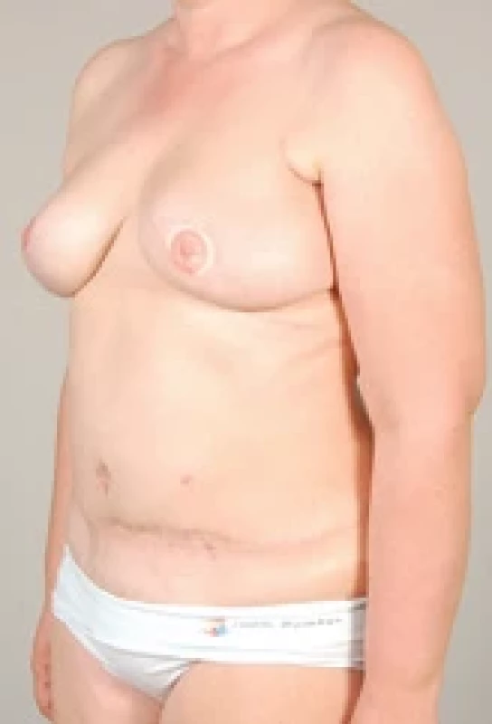 Final result after secondary nipple reconstruction and nipple-areolar tattoo.