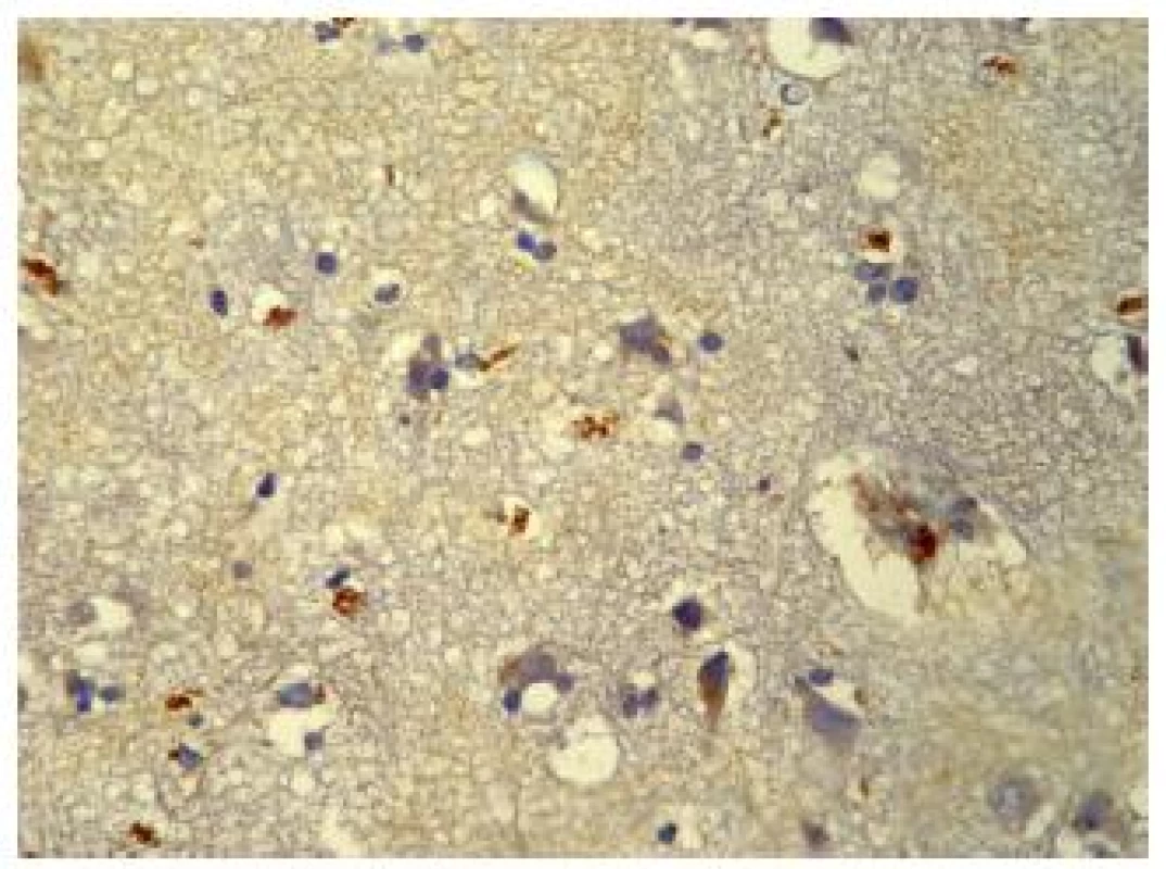 A 75 years old man falling down to the ground striking his head. VEGF immunopositivity was identified inside cytoplasm of neurons, astroglial cells, and in perivascular spaces. Perivascular and pericellular oedema was revealed in contusions area.