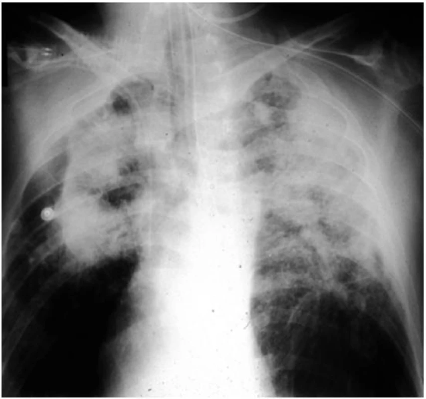 Komplikovaná silikóza plic
Ve středních a horních segmentech plic jsou jasně patrné splývající opacity o velikosti nad 10 mm.