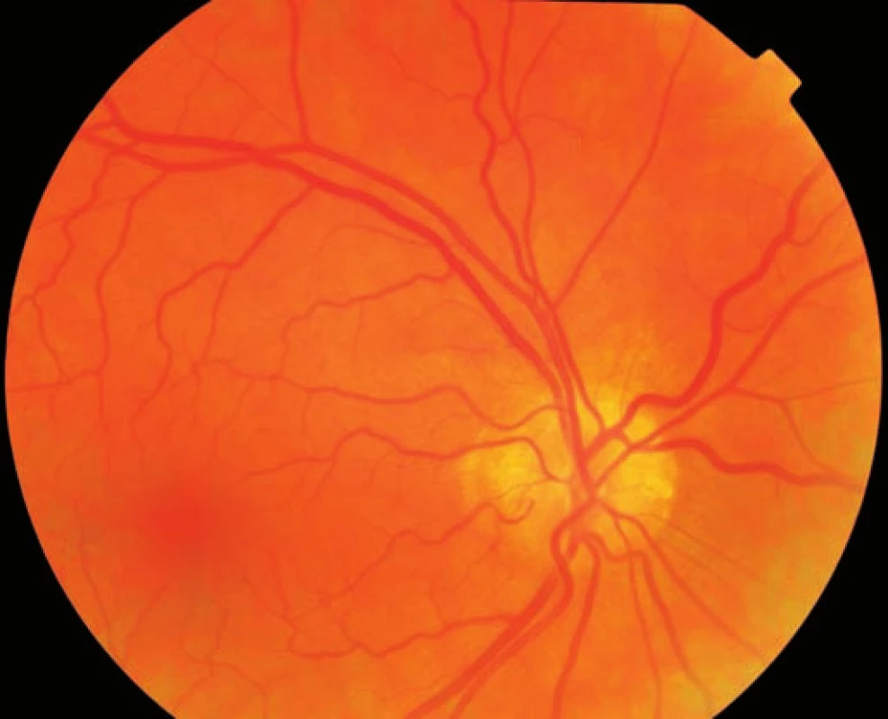 Fundus fotografia pravého oka (pacient č. 1). 
Viditeľné drúzy na povrchu papily zrakového nervu hlavne hore a nazálne, tortuozita nazálnych venóznych vetiev.