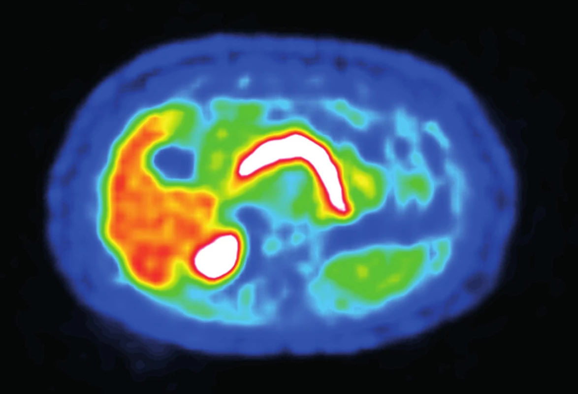 PET/CT
Fig. 3: PET/CT