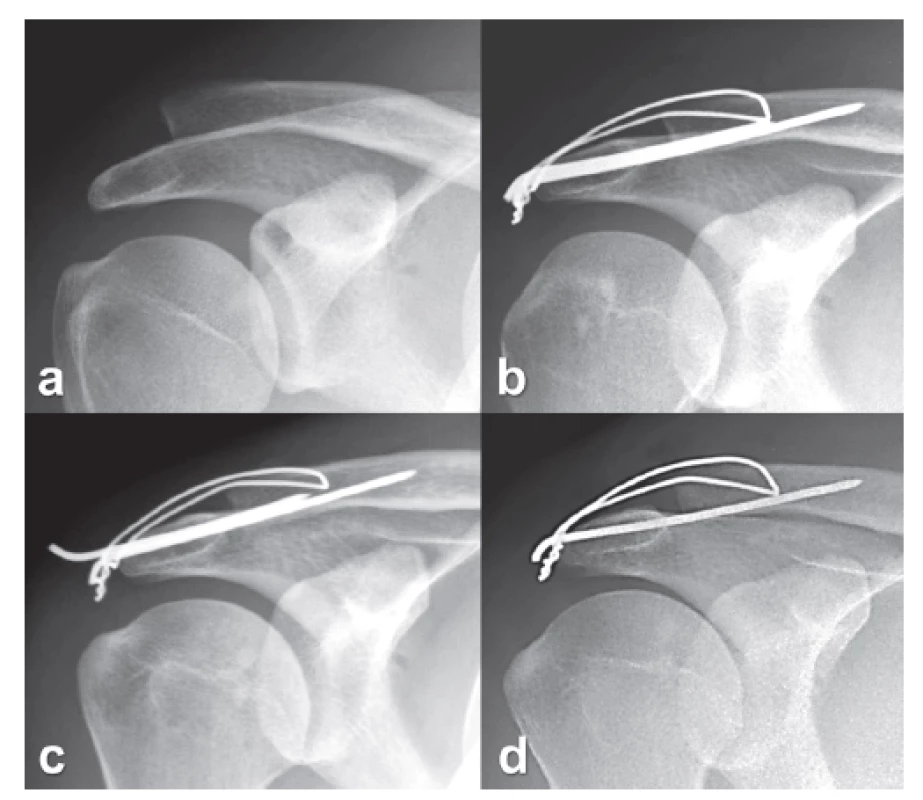 Migrace K-drátu s následným selháním osteosyntézy: a − AC luxace typ Rockwood 3, 
b − stabilizace tahovou cerkláží, „dolní“ poloha K-drátů v klíčku, c – migrace K-drátu 4 týdny po operaci, minimální redislokace AC kloubu, d – výrazná redislokace AC kloubu po extrakci migrujícího K-drátu pro dráždění kůže.
Fig. 6: Migration of K-wire with subsequent failure of internal fixation: a - AC dislocation of Rockwood type 3, b – stabilization by tension wire cerclage, “low” placement of K-wires in the clavicle, c – migration of K-wire 4 weeks after the surgery, minimal redislocation of the AC joint, d – marked redislocation of the AC joint after extraction of the migrating K-wire for skin irritation.