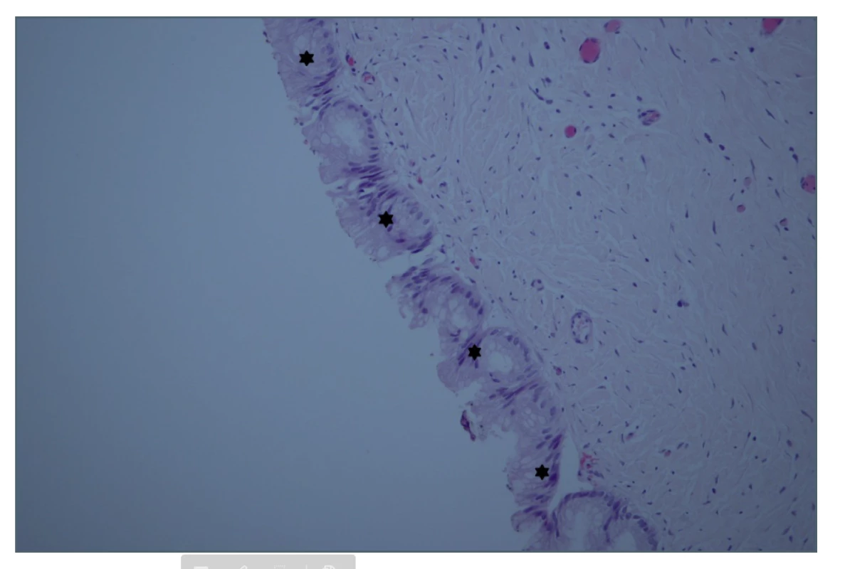 Histologický řez, peritoneum, hematoxylin-eosin<br>
Hvězdičky označují ložiska tumoru na peritoneu.<br> 
Fig. 2: Biopsy section, peritoneum, HE staining<br>
Stars indicate the peritoneal tumour foci.