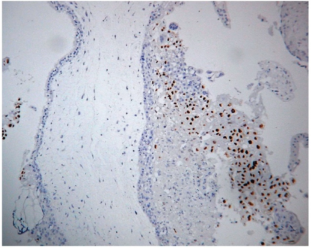 Expresia 57 v kompletnej hydatidóznej mole. Imunohistochemická reakcia s monoklonálnou protilátkou p57 (57P06). Silná jadrová pozitivita extravilózneho trofoblastu, negativita vilózneho cytotrofoblastu a stromálnych buniek klkov. Vizualizácia DAB (zväčšenie 200x).