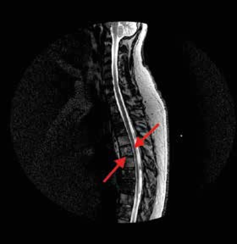 MRI hrudní páteře, sagitální řez.