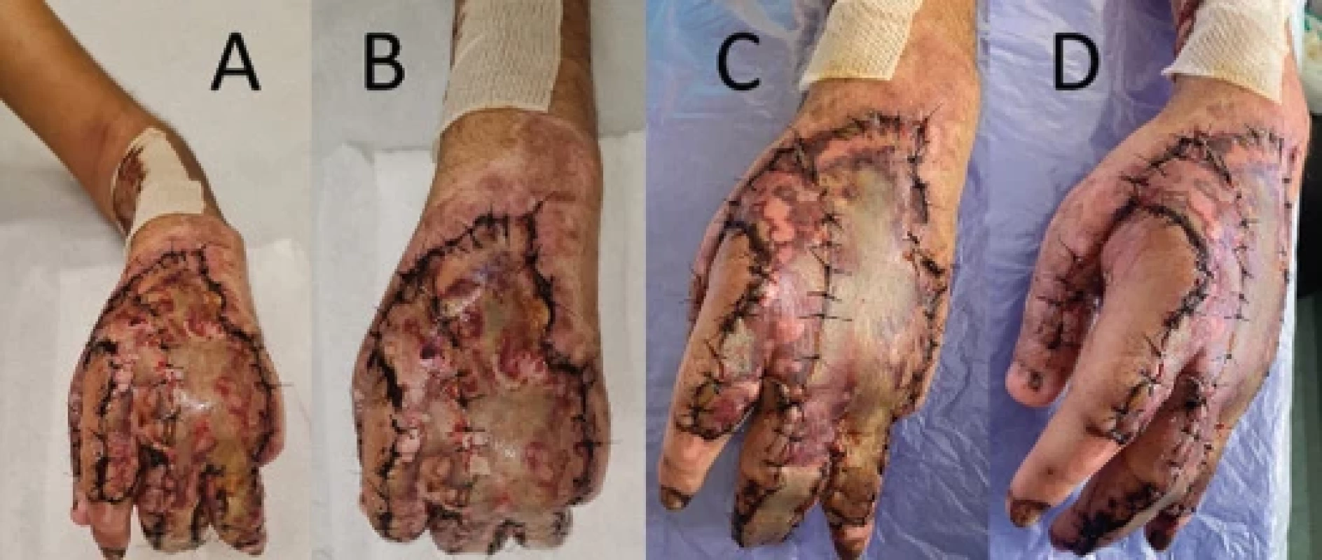 A, B) Opening of the dressing after 7 days; C, D) opening of the dressing after 14 days of the skin graft, showing good integration of the skin with the recipient bed.
