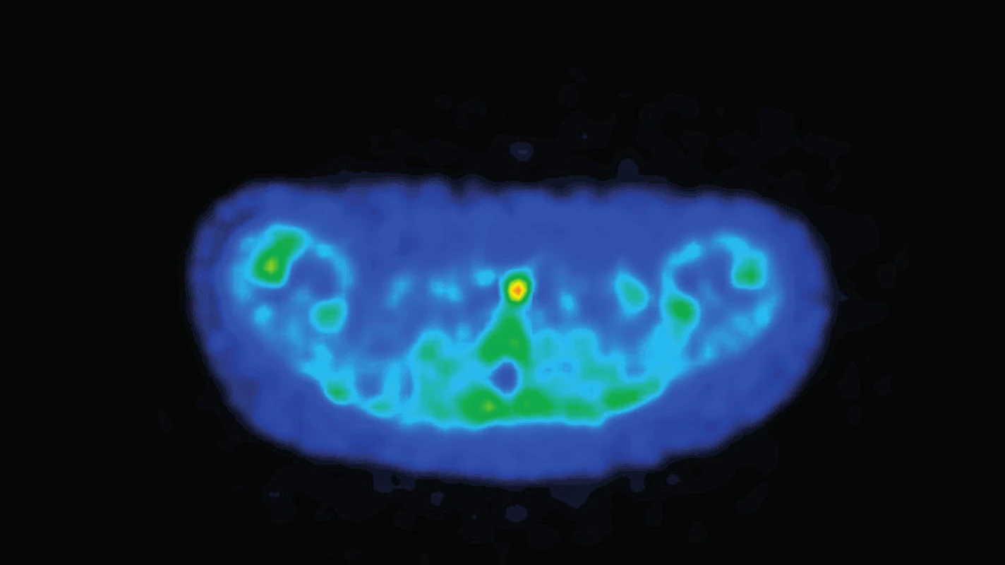 Pozitrónová emisná tomografia.
Fig. 2. Positron emission tomography.