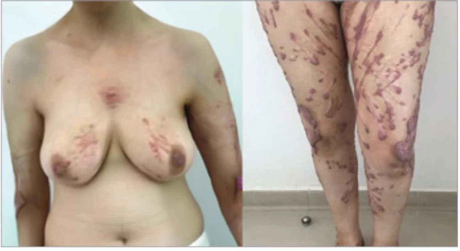 Keloidal scars of varying size scattered over the body.