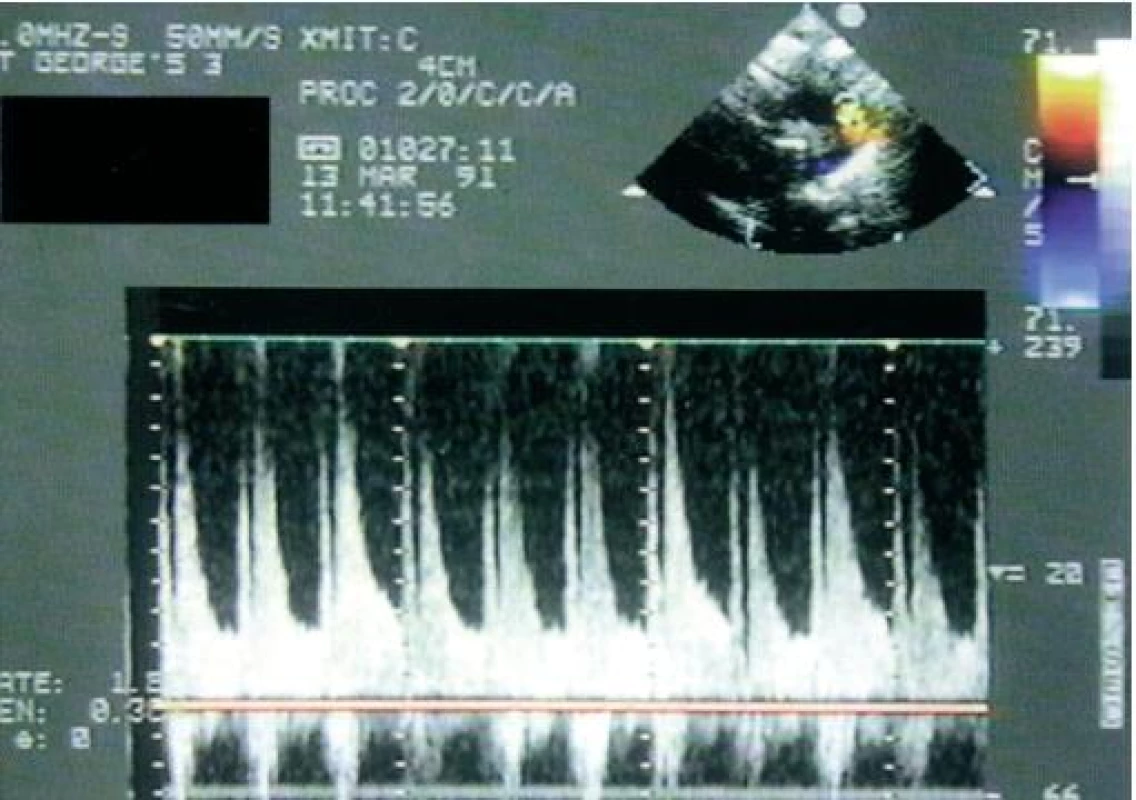 U velké dučeje vysoký diastolický tok rychle snižuje aorto-pulmonální tepenný tlakový gradient a vytváří na kontinuálním spektrálním dopplerovském zobrazení vzorec toku s hlubokými zuby pily.