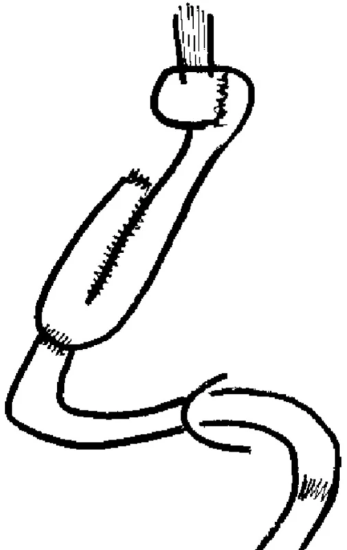 Schéma J-pouche s antirefluxní manžetou
Pic. 1. Scheme of J-pouch with the antireflux cuff