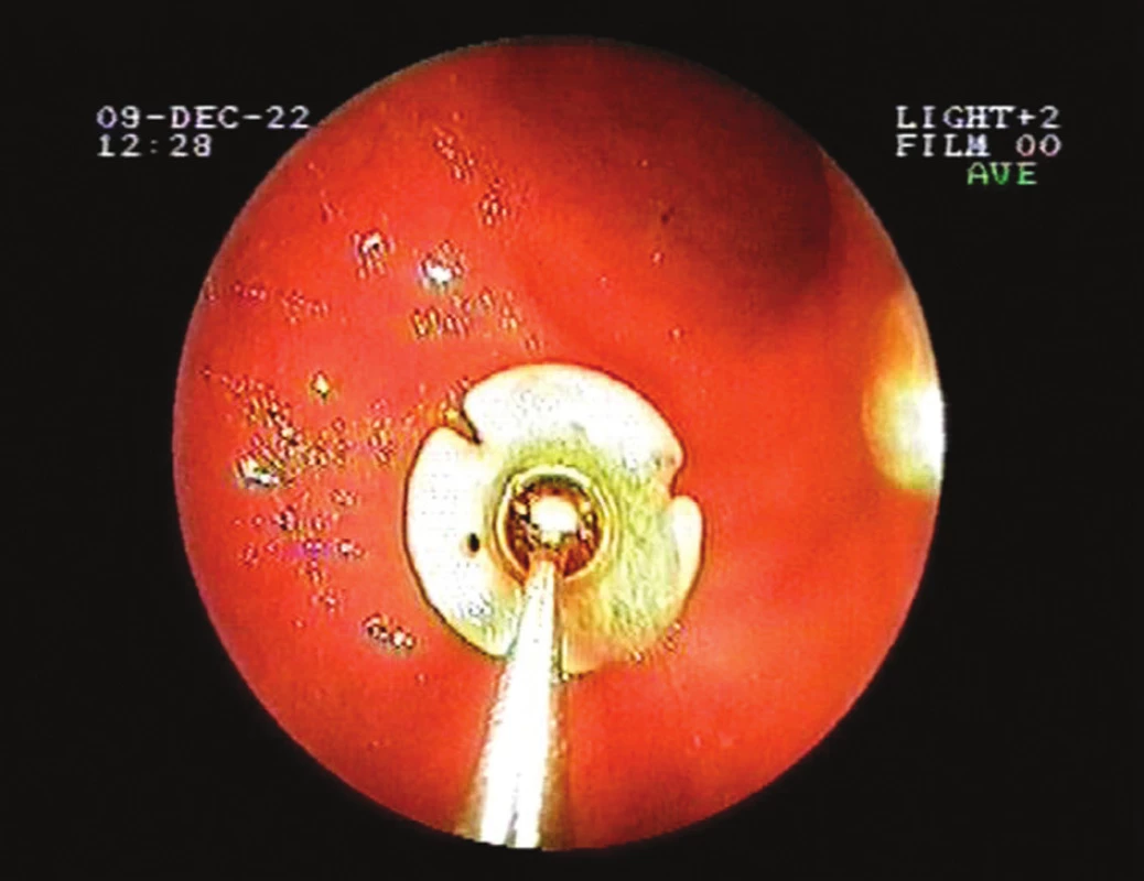 Endoskopický pohled – normální pozice fixační plošky
Fig. 1. Endoscopic view – the normal position of retention plate