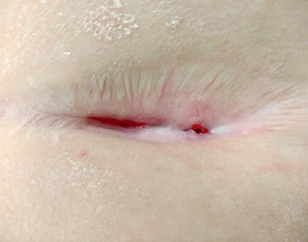 Chronická píštěl v jizvě pravého hypochondria po důkladné toaletě rány po laparoskopické cholecystektomii.
