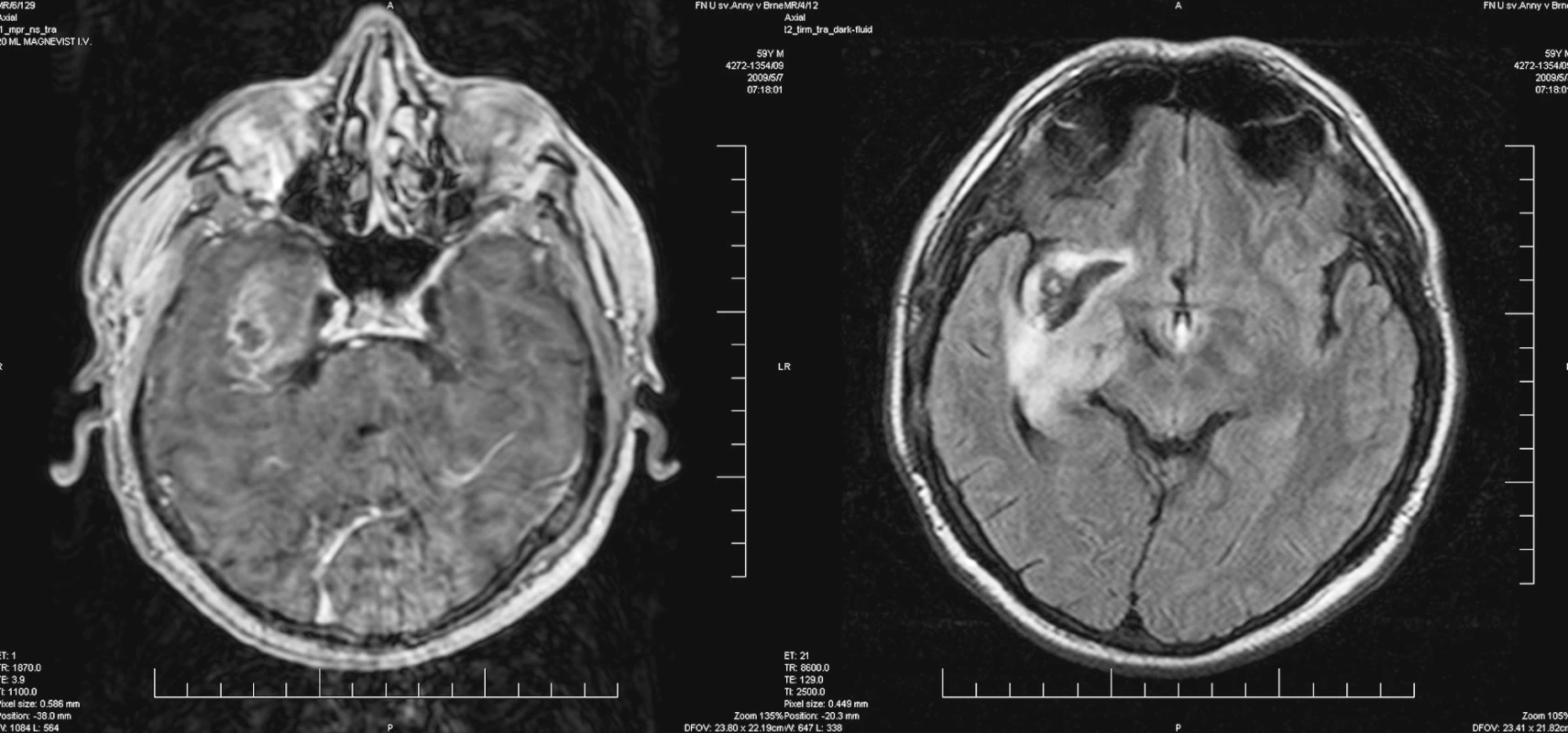 Vyšetření MRI – průkaz sytící se nádorové tkáně na bázi temporálního laloku (vlevo), další ložisko prokrvácení v oblasti inzuly
Pic. 4. MRI – enhancing tumor tissue affecting temporal lobe base (left picture), another bleeding focus affecting insula