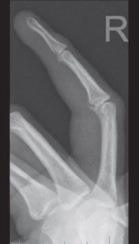 A stable proximal interphalangeal joint volar plate injury suitable for non-operative treatment.