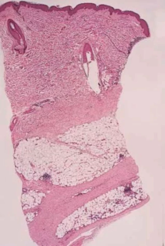 Morfea profunda – histologický obraz – ztluštělé septum podkožního tuku (převzato z 6)