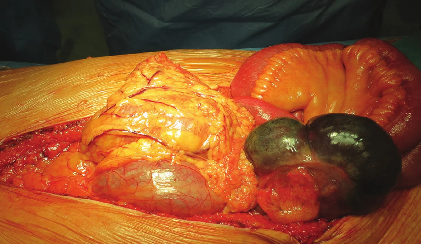 Perioperační nález ischemické gangrény céka
Fig. 14: Perioperative finding of ischemic cecal gangrene