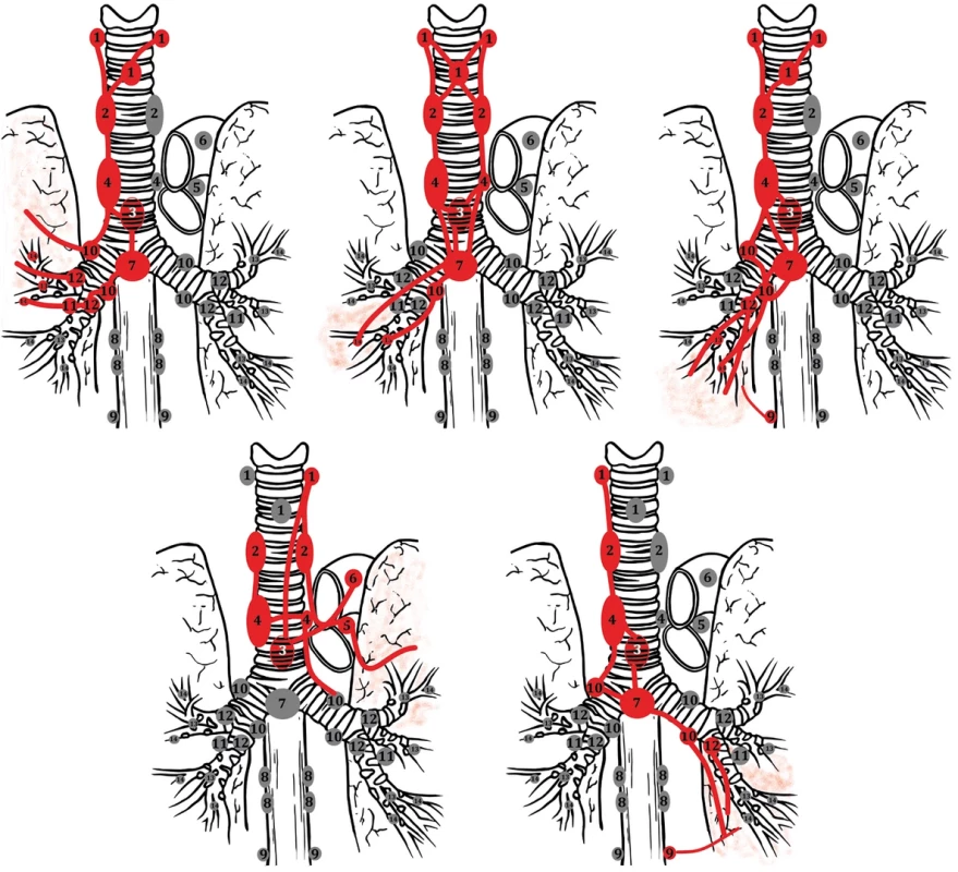 Lymfatický tok z plicních laloků do mediastinálních uzlin   Fig. 1: Lymphatic flow from lung lobes to mediastinal nodes