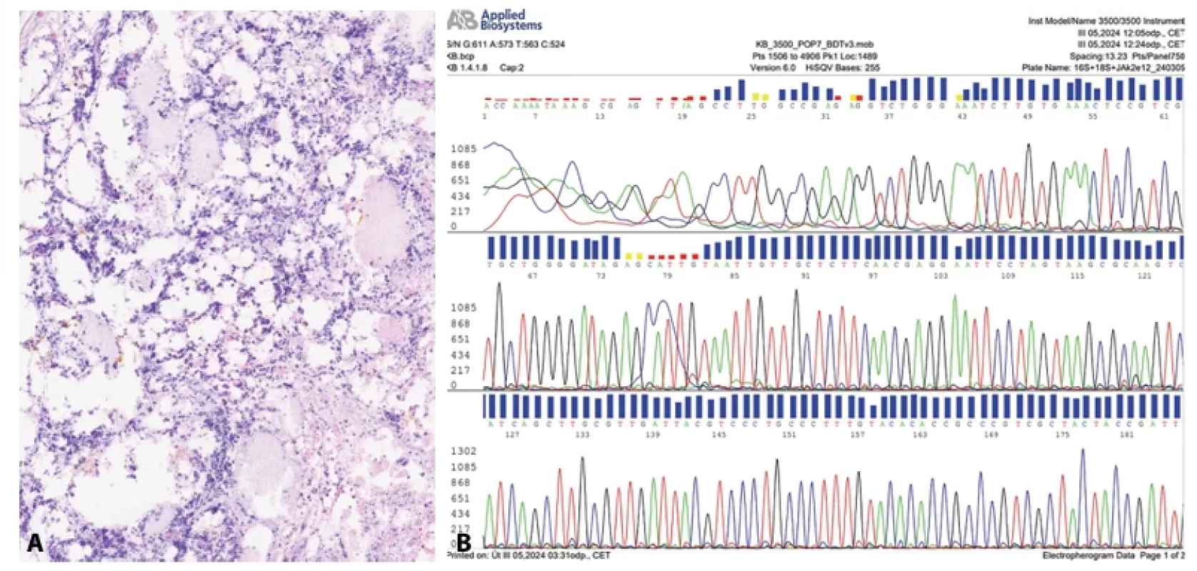 Rod Candida (barveno hematoxylin eozinem, zvětšení 20x). B: Nukleotidová sekvence Candida albicans získaná pomocí Sangerova sekvenování.