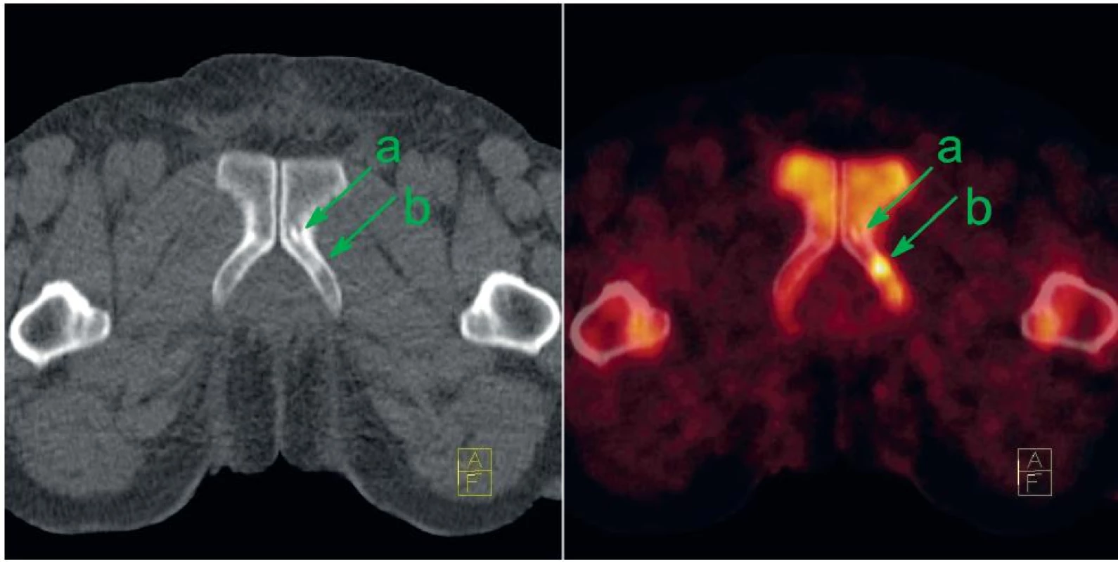 U pacienta s biochemickou recidivou CA prostaty je v CT obrazu patrná drobná osteosklerotická léze na přechodu stydké a sedací kosti vlevo (a). Původní podezření, že by se mohlo jednat metastázu, bylo vyvráceno díky mizivé akumulaci NaF. Jedná se tedy pravděpodobně o vývojový rudiment představující ostrůvek kompakty ve spongióze. Avšak dorzálně od této léze je patrné ložisko intenzivně zvýšené akumulace NaF bez specifi ckého nálezu v CT obrazu, které představuje časnou fázi reakce osteoblastů na přítomnou metastázu (b). Vlevo CT v režimu nízké dávky, vpravo jeho fúze s NaF-PET; sklopené řezy.
Fig. 4. There is small osteosclerotic lesion at the attachment of left pubic and ischiadic bones on the CT (a) at the patient with biochemical recurrence. No NaF uptake excludes metastasis; the lesion represents probably rudimental benign island of cortical bone within spongiosa. On the other hand at the dorsal aspect of this benign lesion, there is a focus of intense NaF uptake without any specific sign on the CT (b). It represents early phase osteoblastic reaction to bone metastasis. Left: low-dose CT; right: fusion of low-dose CT with NaF-PET; tilted slices.