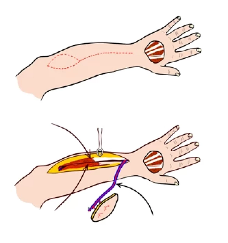 Reverzní PIAF (posterior interosseous artery flap).