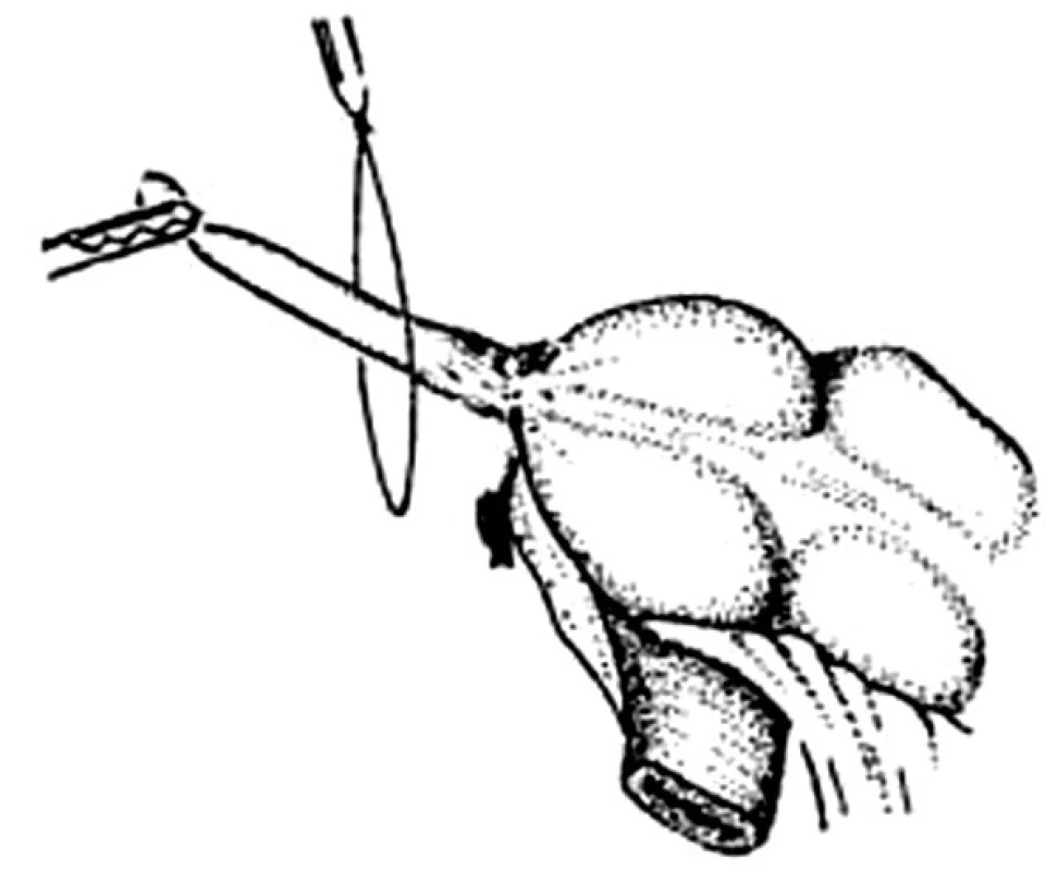 Laparoskopická apendektomie, naložení smyčky na červ
Fig. 5. Laparoscopic appendectomy, the loop is placed over the appendix