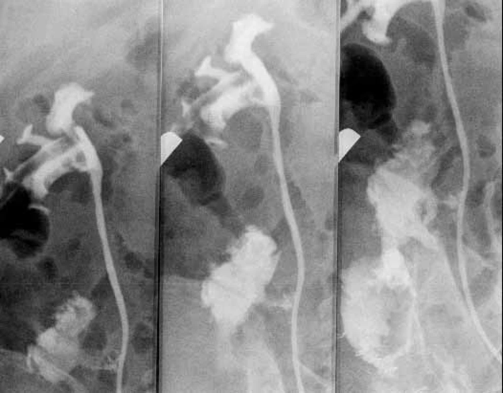 Ascendentní ureteropyelografie – únik kontrastní látky mimo lumen je patrný ve střední části pravého ureteru
Fig. 2. Ascendent ureteropyelography – the kontrast substance escapes outside the lumen in the central part of the right ureter