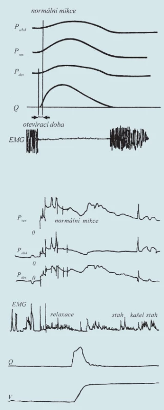 Schéma normální mikce a synchronní záznam při urodynamickém vyšetření (křivky shora: P<sub>ves</sub>, P<sub>abd</sub>, P<sub>det</sub>, EMG, průtok, mikční objem).