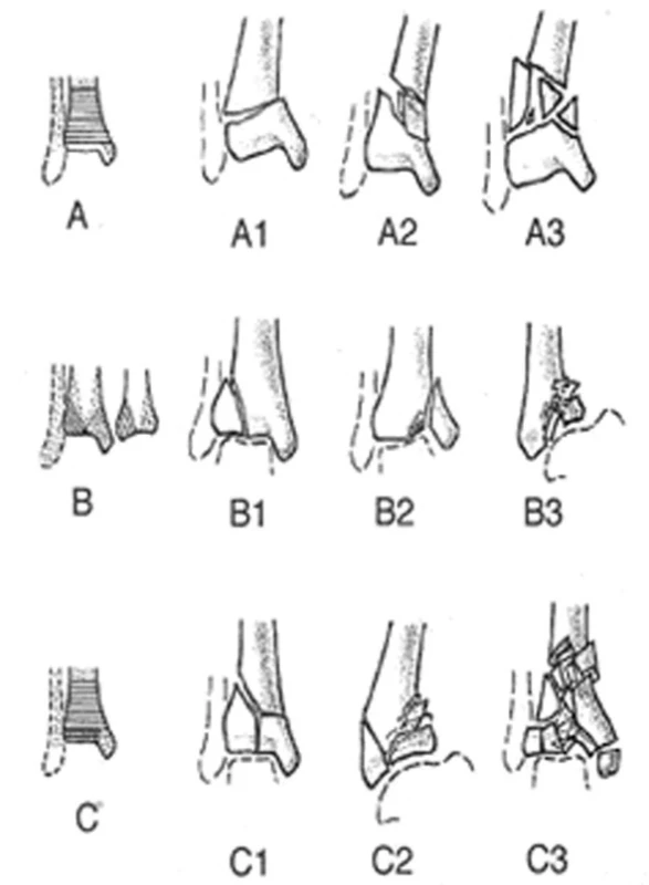 Klasifikace zlomenin dle AO
Fig. 1: Classification of fractures according to AO