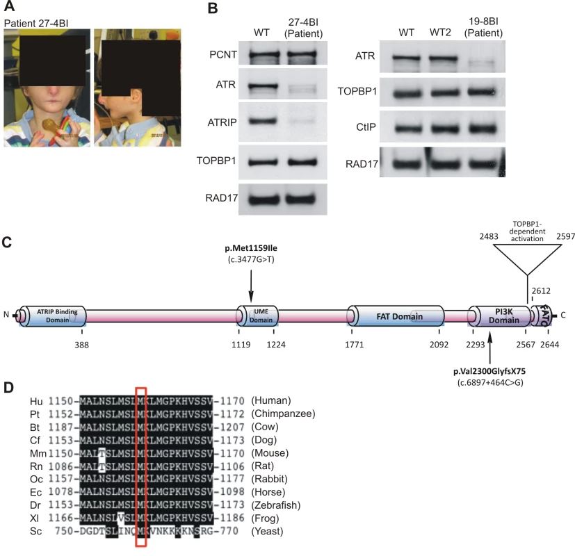 Patients 27-4BI and 19-8BI have reduced ATR and ATRIP expression and mutations in ATR.