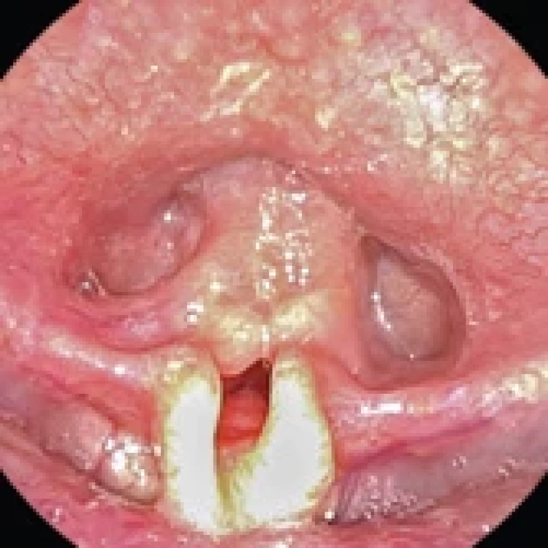 Laryngomalacie, fl exibilní laryngoskopie, dle Olney typ I (nadbytek tkání arytenoidních hrbolů, které jsou nasávány nad nitro hrtanu) a II (zkrácené aryepiglotické řasy, omegovitá epiglotis). Fig. 1. Laryngomalacia, fl exible laryngoscopy, type I (prolapsing supra arytenoid fl oppy tissue) and II (shortened aryepiglottic folds, omega- -shaped epiglottis) according to Olney.