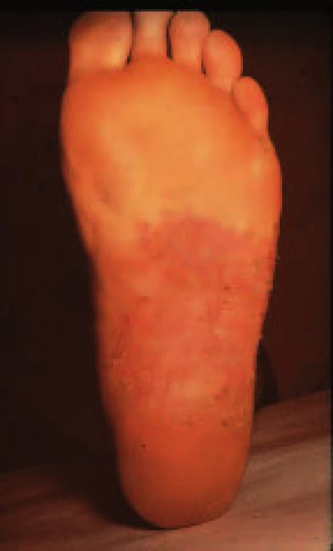 Tinea pedum: d) vezikulózní forma.