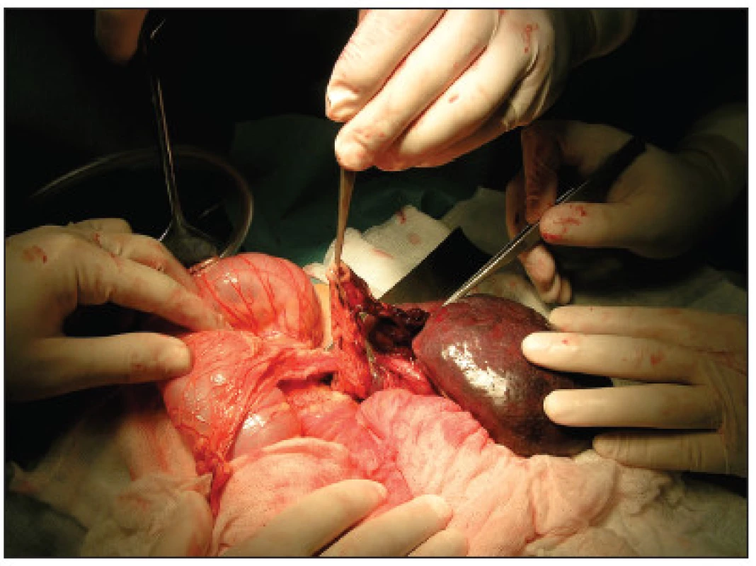 Torkvovaná slezina s prichyteným cípom omenta
Fig. 2. Torsion of spleen with omental adhesion