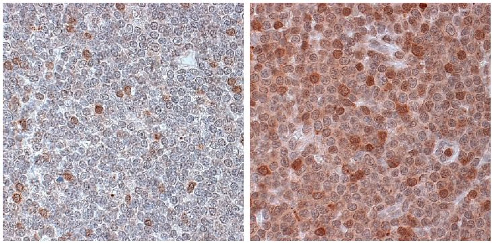 a–b. Imunohistochemická detekce ZAP-70 v preparátu z exstirpované lymfatické uzliny u nemocného s B-CLL. Použita monoklonální protilátka anti-ZAP-70 (klon 2F3.2, Upstate), vizualizace pomocí LSAB2 kitu (DakoCytomation).