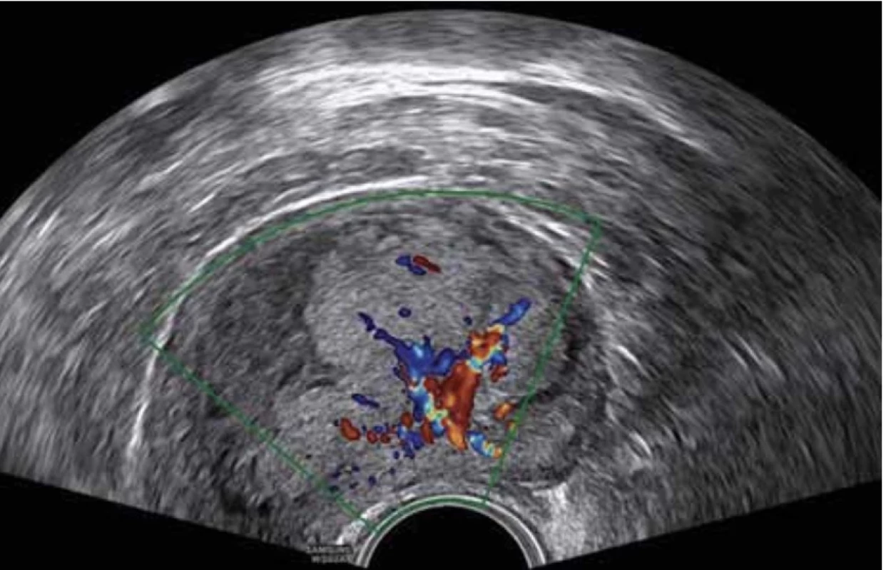 Karcinom endometria – vysoké endometrium, nepravidelná endo-myometrální junkce, bohaté cévní zásobení (CS 4), více cév z jednoho vstupu. // Endometrial cancer – thick endometrium, irregular endo-myometrial junction, abundant color flow (CS 4), multiple vessels with multifocal origin.