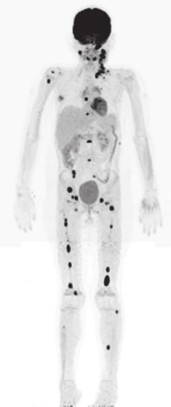 Celotelové PET/CT s <sup>18</sup>F-FDG. Mnohopočetné metastázy v kostnej dreni, lymfatických uzlinách krku bilat. a supraklavikulárnej oblasti vľavo, infiltrácia ľavej sfenoidálnej a maxilárnej dutiny. (SUVmax: 9-15). [19.02.2014]
