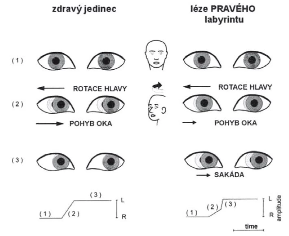 Head impulse test (provedení u zdravého jedince – vlevo, u pacienta s pravostrannou periferní vestibulární lézí – vpravo. Zde po skončení pohybu je generována korekční sakáda.